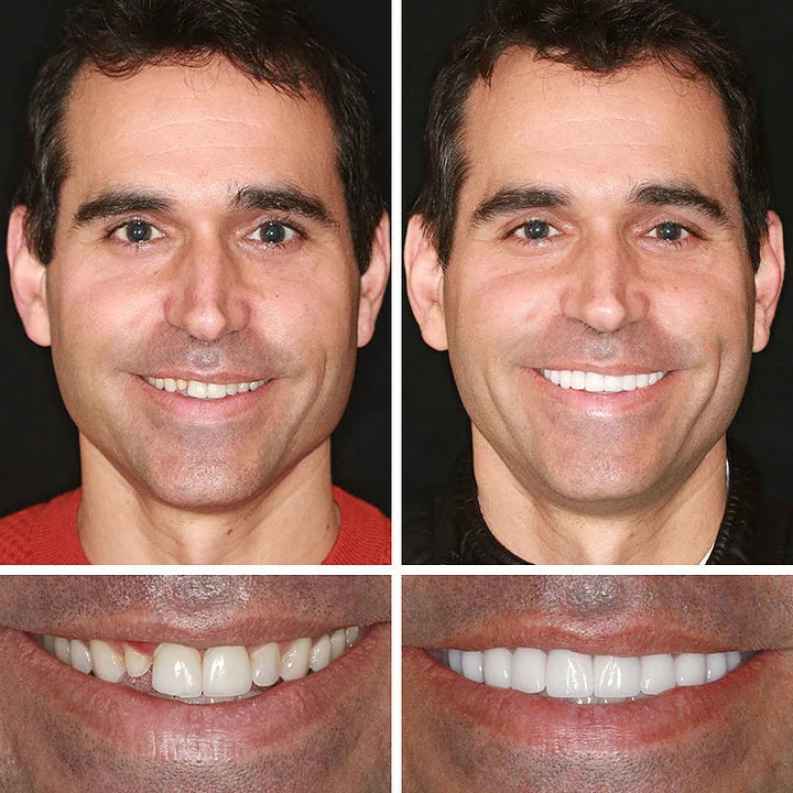 🦷𝐌𝐞𝐝𝐢𝐜𝐚𝐥-𝐆𝐫𝐚𝐝𝐞 𝐃𝐞𝐧𝐭𝐮𝐫𝐞𝐬 | 𝐍𝐚𝐭𝐮𝐫𝐚𝐥 𝐂𝐨𝐦𝐟𝐨𝐫𝐭 𝐅𝐢𝐭 𝐟𝐨𝐫 𝐈𝐧𝐬𝐭𝐚𝐧𝐭 𝐂𝐨𝐧𝐟𝐢𝐝𝐞𝐧𝐭 𝐒𝐦𝐢𝐥𝐞